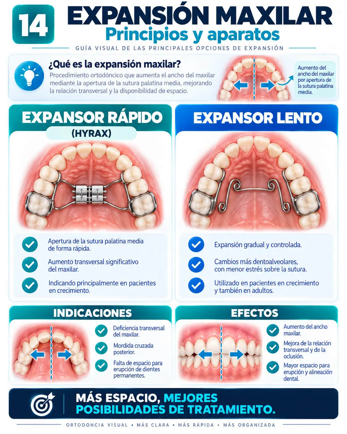 Expansión Maxilar